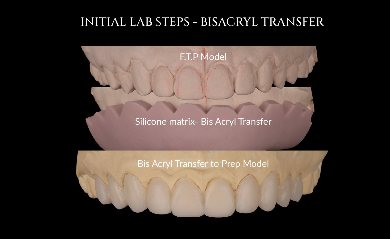 Bisacryl transfer initial lab steps